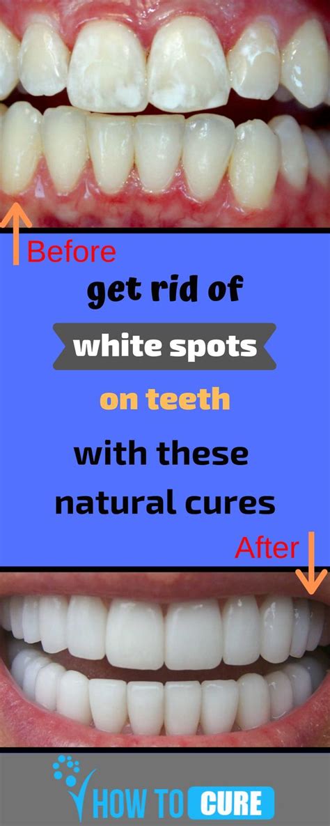 Awasome How To Get Rid Of White Spots On Teeth At Home 2022