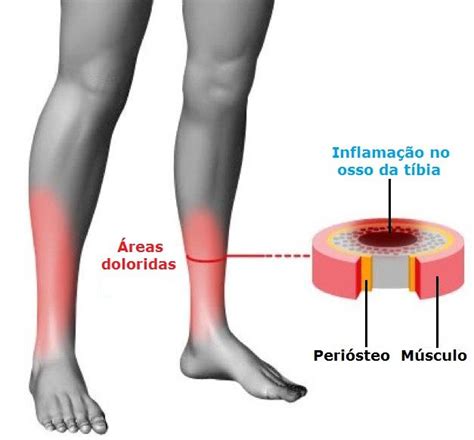 Periostite Inflamação Do Tecido Conjuntivo Dos Ossos Saúde