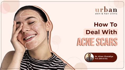 Acne Scars Causes Types Prevention And Treatments Get Rid Of Acne