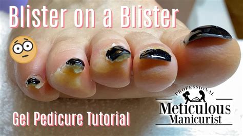 👣watch How I Remove Blisters From Running On Toes With Gel Polish👣