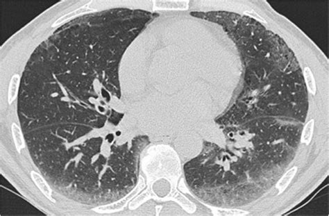 Idiopathic Pulmonary Fibrosis Prognostic Impact Of Histologic