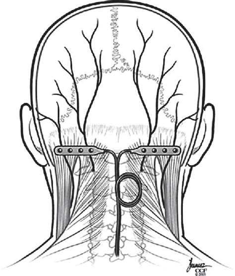 Figure 2 From Peripheral Nerve Stimulation For Occipital Neuralgia