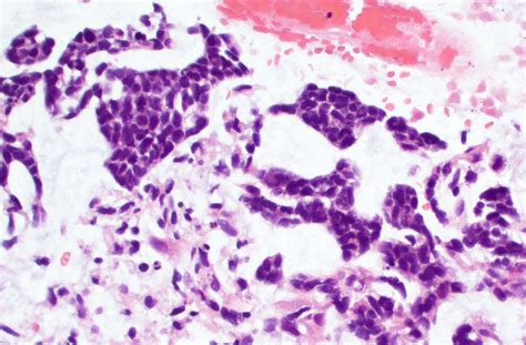Pathology Outlines Glioblastoma Idh Wild Type