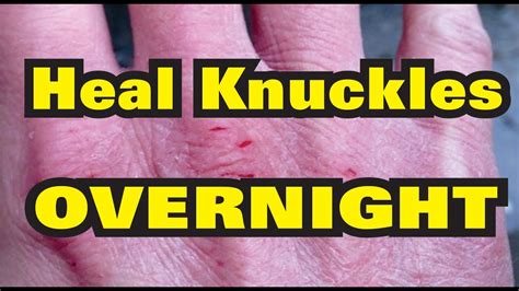 Heal Cracked Dry Bleeding Knuckles Overnight Youtube