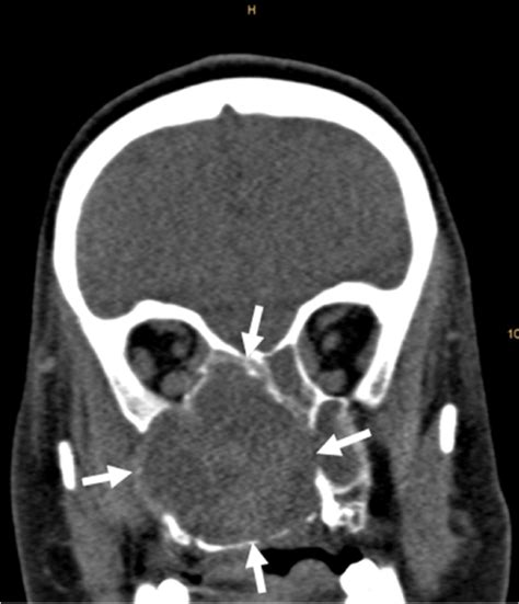 Rare Case Of An Aneurysmal Bone Cyst Of The Skull