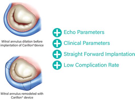 Indirect Mitral Annuloplasty Using The Carillon Device Cardiac Dimensions