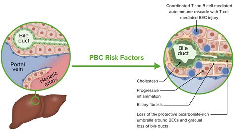 Primary Biliary Cholangitis Clinical Concise Medical Knowledge
