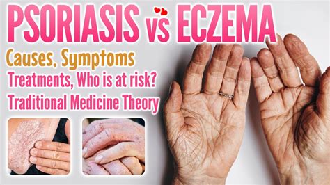 Psoriasis Vs Eczema Causes Symptoms Treatment Traditional Medicine