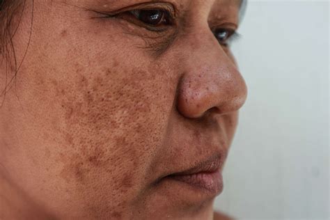Skin Discoloration Causes And Treatments
