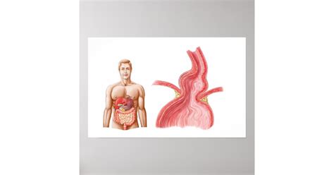 Medical Ilustration Of A Hiatal Hernia In The Poster Zazzle