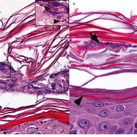 Canine Epidermal Collarettes Clinical Lesions Acd Annular To