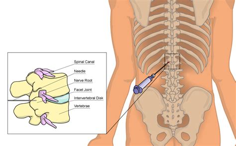 Spinal Injections For Pain Management Sapna Pain Management Blog