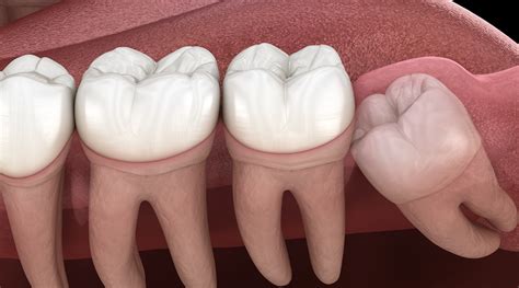 Treatment Options For Impacted Teeth Udenz Mena Dental Platform