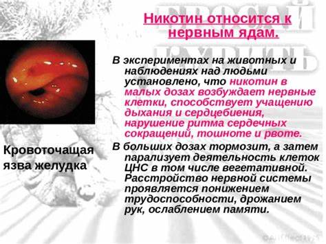 Кровоточащая язва диета Презентация "Вредные привычки" - всем учителям, презентации Презентация "Вредные привычки" - всем учителям, презентации Кровоточащая язва диета