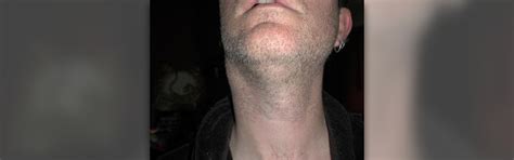 Swollen Glands In Neck General Center