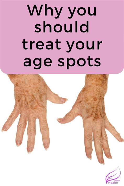 How To Get Rid Of Age Spots Causes And Treatment In 2020 Age Spots