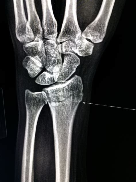 Xray Of Wrist Shows Very Common Fracture Colles Of The Radius