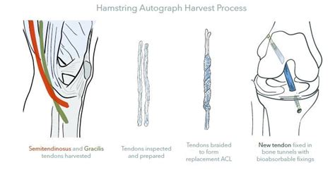 Acl Tear Surgery Procedure Acl Reconstruction Treatment Procedure