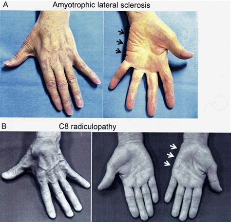 The Split Hand Syndrome In Amyotrophic Lateral Sclerosis Journal Of