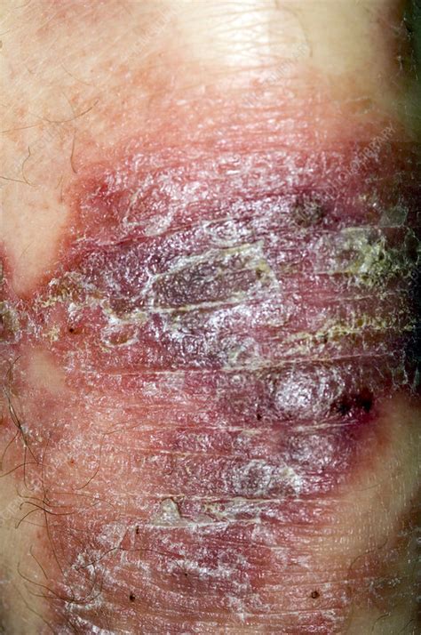 Psoriasis Skin Disorder Stock Image M2400715 Science Photo Library