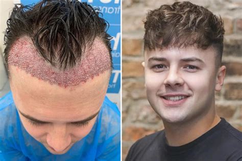 Is Hair Transplant Only Solution A Complete Roadmap Hairstyles