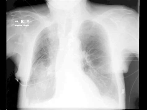 Pulmonary Infiltrates In Icu Youtube