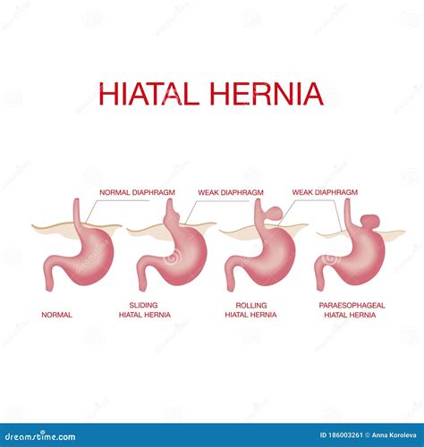 Hiatale Hernia Hiatale Hernia En Normale Anatomie Van De Maag Vector