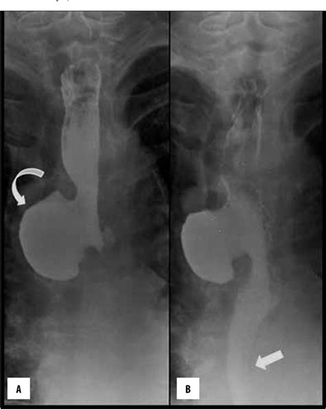 Figure 1 From Mid Esophageal Diverticulum Mimicking An Aortic Aneurysm On Chest Radiography