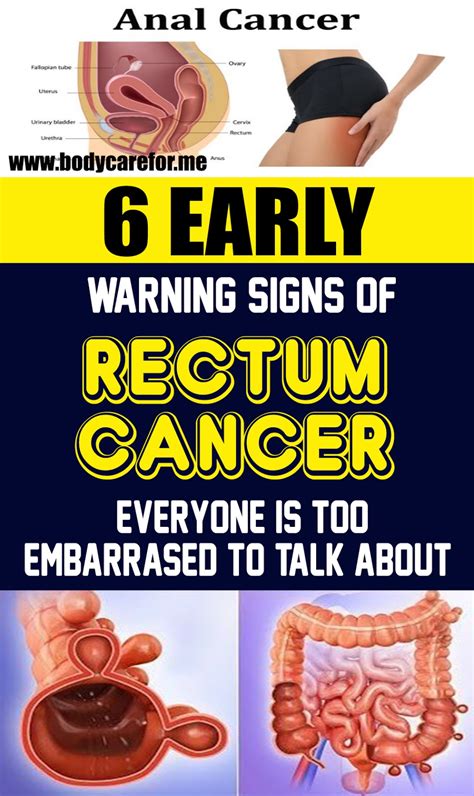 6 Unusual Signs Of Anal Cancer You Shouldn T Ignore