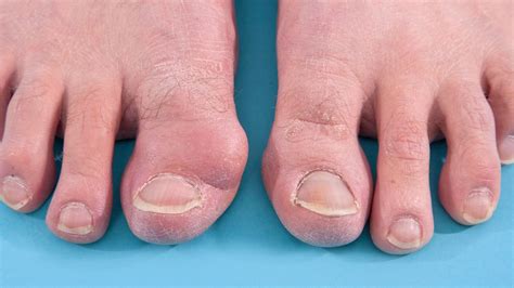 Big Toe Bunion All About Symptoms Causes And Pain Relief Treatments
