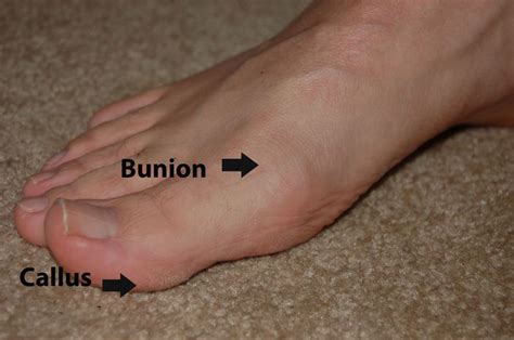 Common Toe Problems That Can Make Feet Look Abnormal