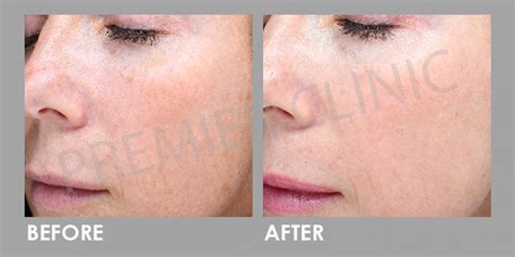 Large Pores Tightening With Carbon Peel Laser Premier Clinic