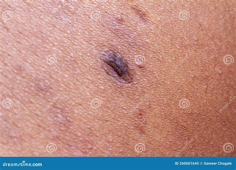 Human Skin Texture Wart And Pimples On Skin Micro Photo Stock Image