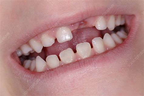 Missing Front Tooth Stock Image P4860162 Science Photo Library