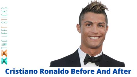 Cristiano Ronaldo Before And After His Plastic Surgery Secrets Revealed