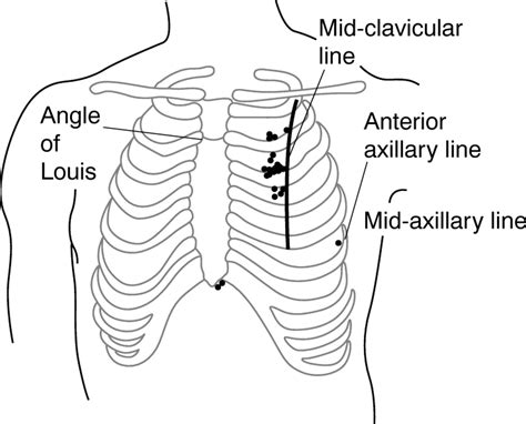 Anterior to mid axillary line, posterior to pectoral groove, above 5th intercostal space. Trick of the Trade: Don't miss the pneumothorax in needle ...