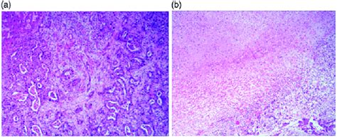 A Left Hepatic Lobectomy Was Performed And Postoperative Pathology