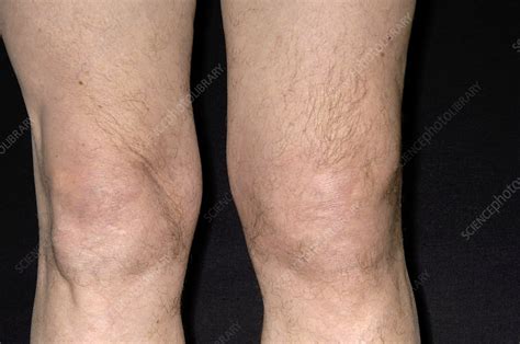 Swollen Knee Stock Image M330 1436 Science Photo Library