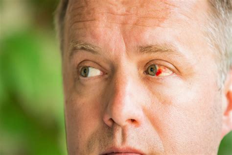 Subconjunctival Hemorrhage Broken Blood Vessel In The Eye Causes
