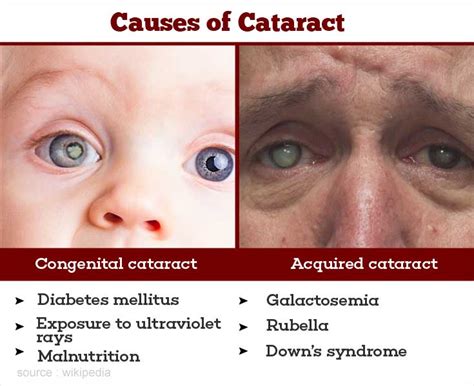 Cataract Causes Symptoms Diagnosis Treatment Prevention