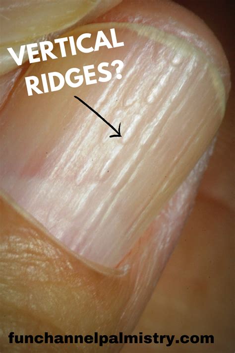 Do You Have These Vertical Ridges On Your Nails Palmistry Artofit