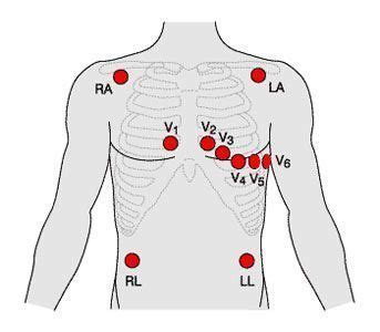 Learn about correct ecg placement, importance and use. 12 Lead ECG Placement | Nurse, Medical, Icu nursing