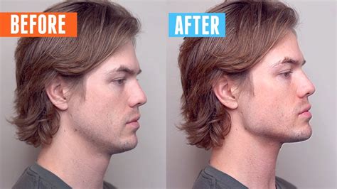 How To Fix Your Side Profile Without Surgery Update