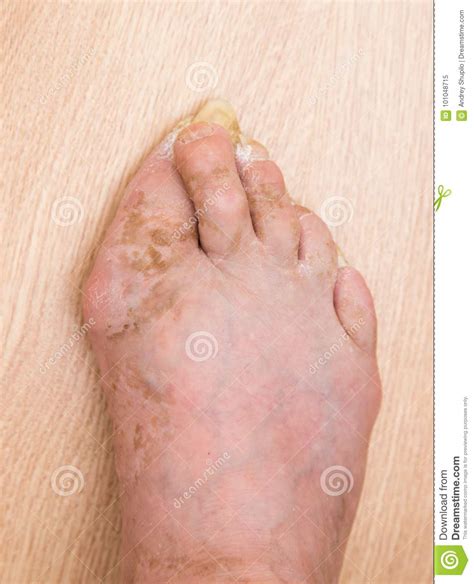 Fungus Infection On Nails Of Man`s Foot Stock Image Image Of Care