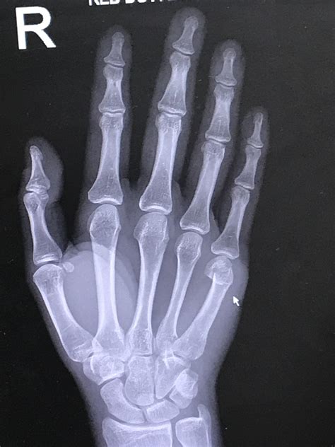 Will This Fracture Of My 5th Metacarpal Bone Require Surgery To Correct
