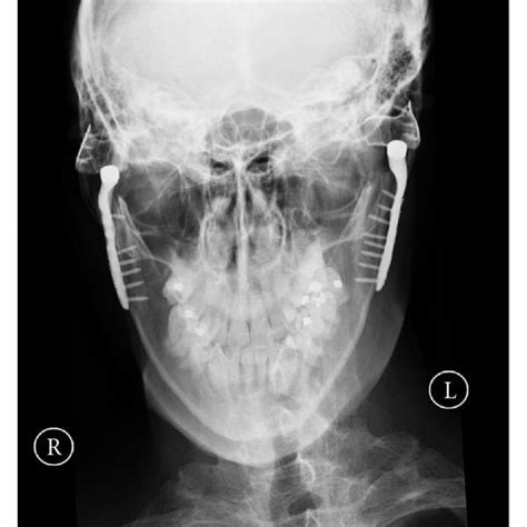 Postoperative Pa Mandible Radiograph Showing Tmj Concepts Prostheses In