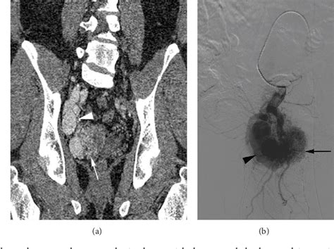 Figure From Concomitant Transarterial And Transvenous Embolization Of A Pelvic Arteriovenous