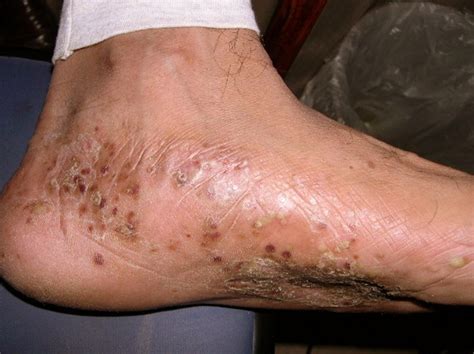 Find & download free graphic resources for cactus thorns. Pompholyx - Pictures, Symptoms, Treatment, Diagnosis ...