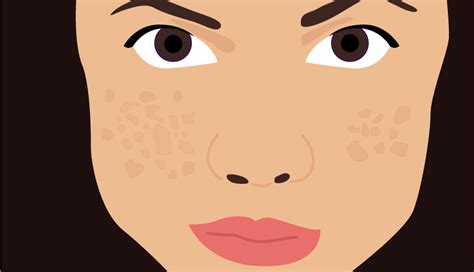 How To Treat Acne Scars Self