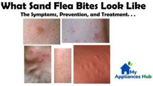 Sand Flea Bites Jigger Symptoms Prevention Treatment Tungiasis